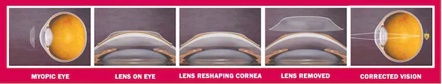 Stages of Ortho-K: myopic eye, lens on eye, lens reshaping cornea, lens removed, corrected vision